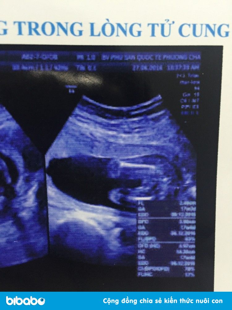 Siêu âm 4D: Hãy khám phá thế giới của thai nhi trong bụng mẹ với siêu âm 4D! Với công nghệ hiện đại, bạn có thể quan sát thai nhi của mình như thật và thậm chí là nhìn rõ những đặc điểm khuôn mặt. Thật đáng kinh ngạc! Hãy xem hình ảnh liên quan để cảm nhận sự thần kỳ của thai nhi trong bụng mẹ.