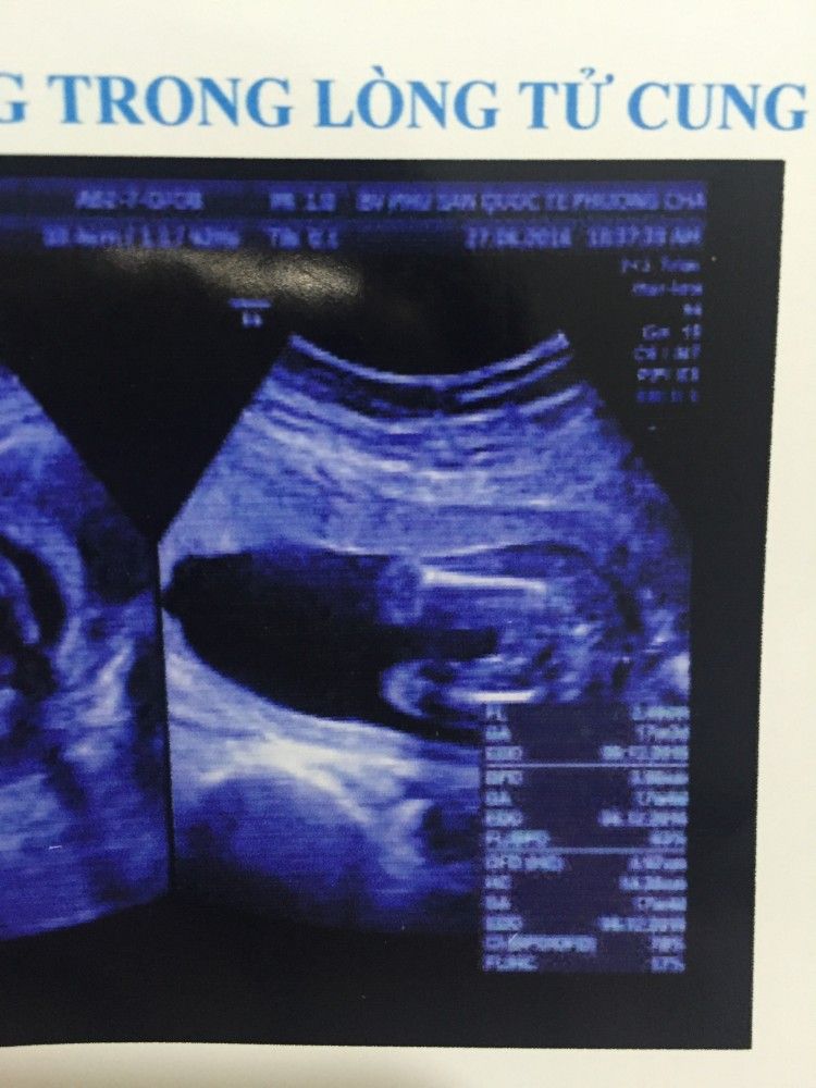 Hình ảnh siêu âm được quay trực tiếp từ bụng mẹ giúp cho các bậc phụ huynh nhìn thấy thai nhi của mình. Bạn có thể xem hình ảnh siêu âm để tận hưởng khoảnh khắc đầy cảm xúc này.