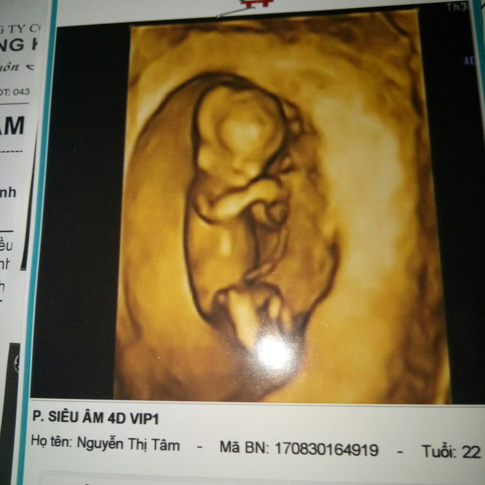 Bạn đang mong chờ thấy hình ảnh của bé nhà đầu thai 12w3d? Hãy xem qua bức ảnh siêu âm này để được khám phá vẻ đẹp của tiny siêu nhân nhà bạn. Thông tin về cân nặng và chiều dài cũng được tiết lộ trong bức ảnh này nữa đấy.