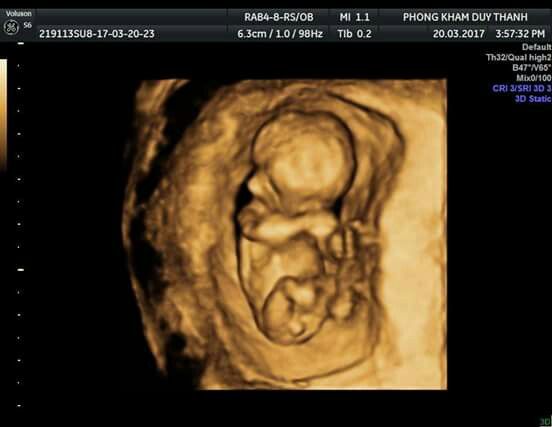 Nếu bạn cảm thấy vui vẻ khi nghe nhịp tim 170/p từ siêu âm 4D của bé trai 12 tuần, hãy xem ngay hình ảnh để chứng kiến nét đáng yêu của con gái và tìm hiểu thêm về sức khỏe của thai nhi.